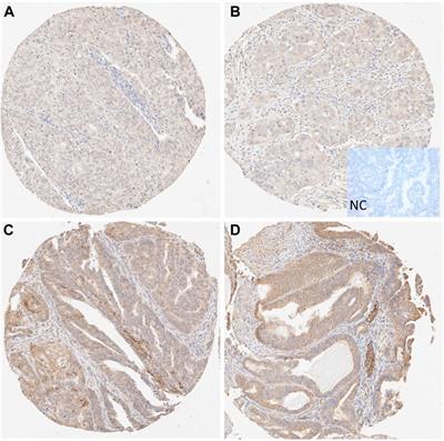 Low Expression of Stanniocalcin 1 (STC-1) Protein Is Associated With Poor Clinicopathologic Features of Endometrial Cancer